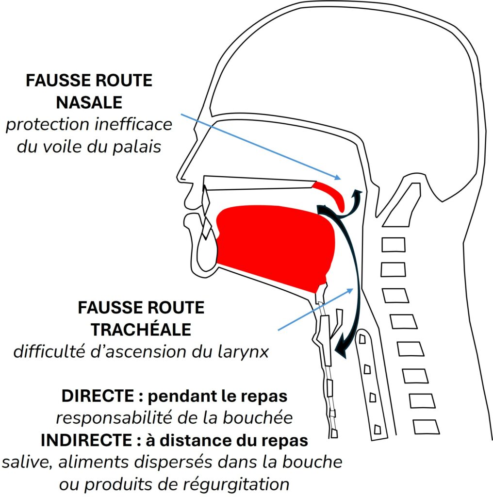 Les mécanismes des fausses routes