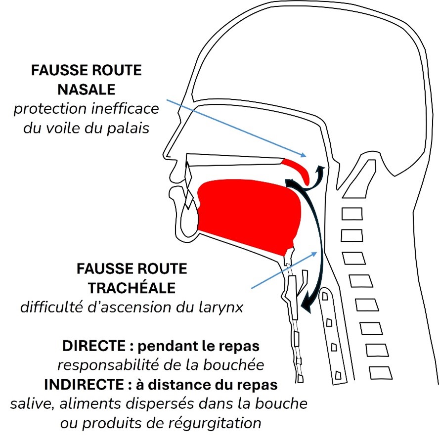 Les mécanismes des fausses routes